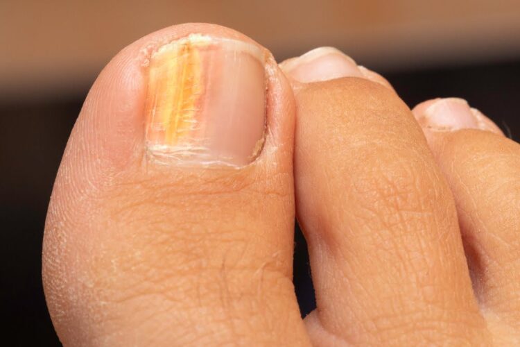 Why Are My Nails Turning Orange