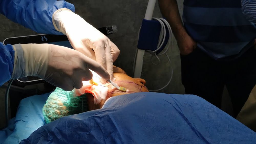 What is Facetite Procedure: Benefits, Complications, Recovery and Cost What is Facetite Procedure: Benefits, Complications, Recovery and Cost