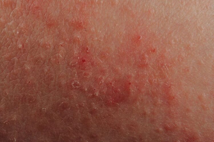 Skin
irritation