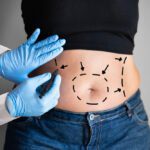 What Happens to the Weight That is Lost Through Liposuction