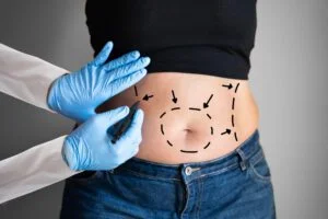 ماذا يحدث للوزن الذي يفقده شفط الدهون؟