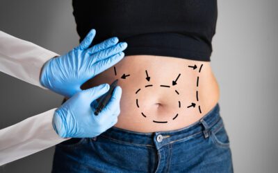 What Happens to the Weight That is Lost Through Liposuction