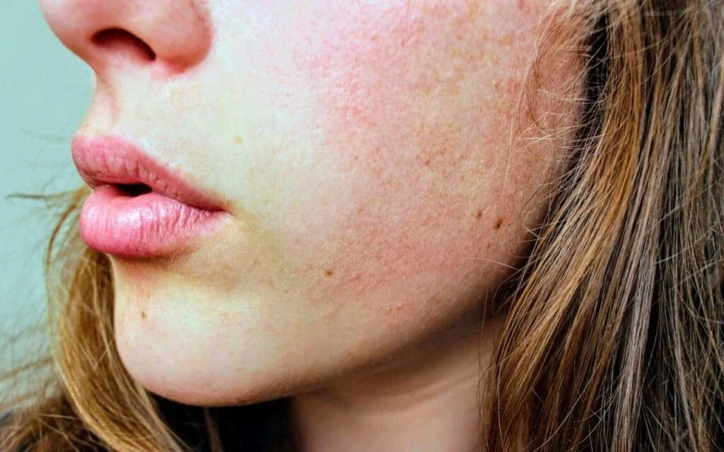 Allergic Reaction To Fake Tan