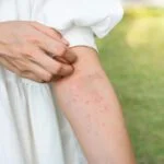 how to treat allergic reaction to fake tan