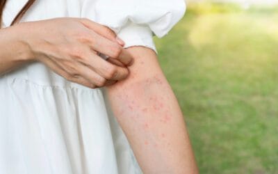 Como tratar a reação alérgica ao bronzeado falso?