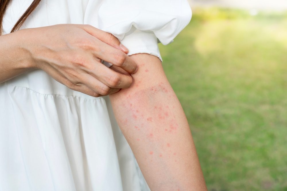 how to treat allergic reaction to fake tan