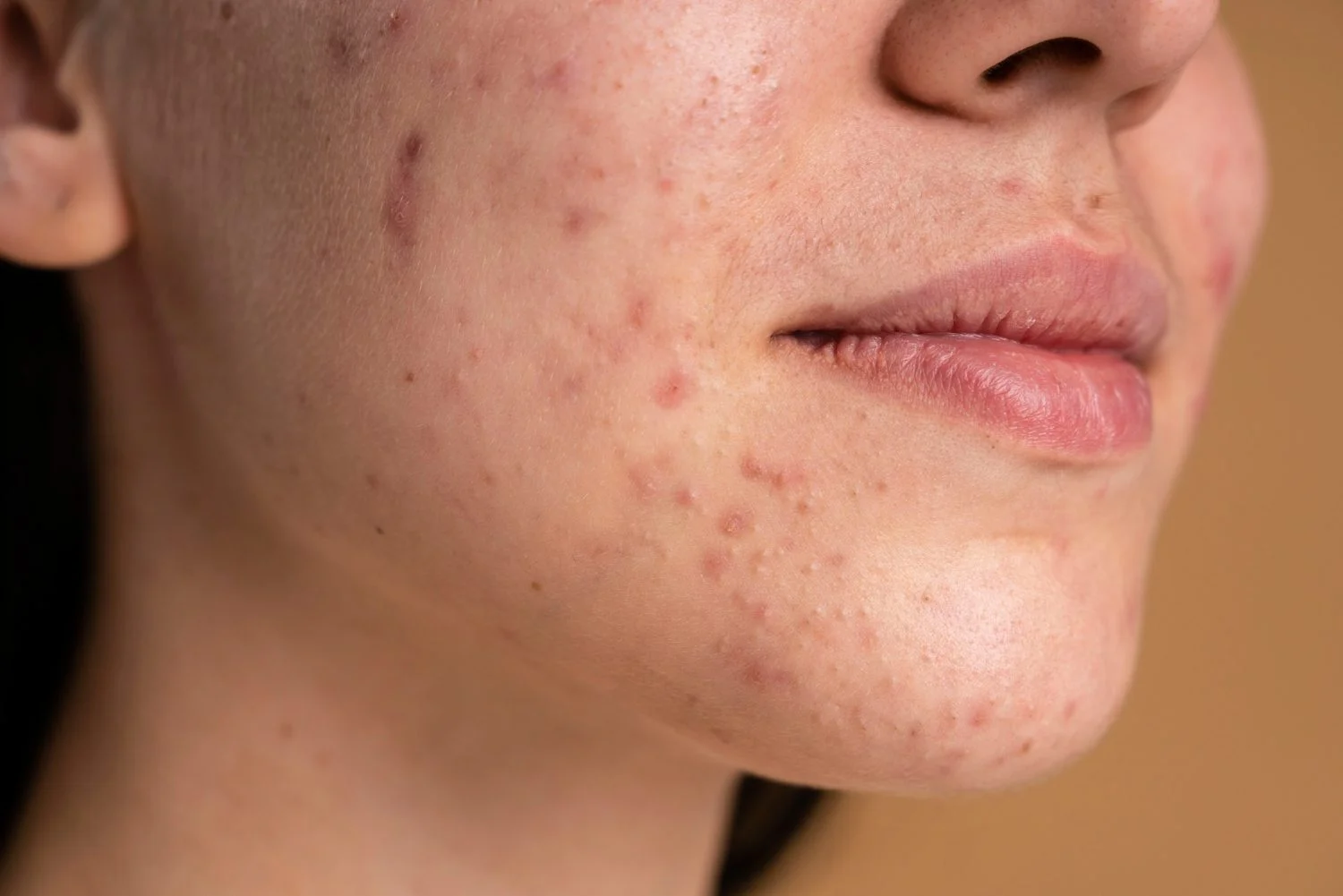 Ácido hialurônico para cicatrizes de acne e acne: benefícios, efeitos colaterais e como usar