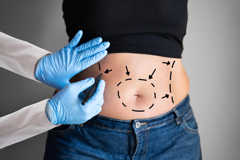 Vaser Liposuction Pros and Cons