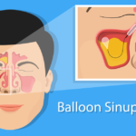 Long-Term Side Effects of Balloon Sinuplasty