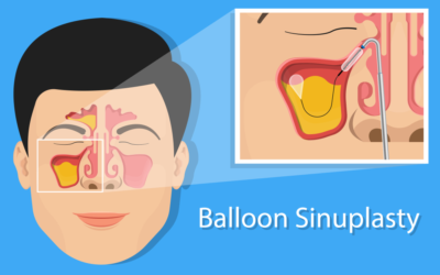 Long Term Side Effects of Balloon Sinuplasty