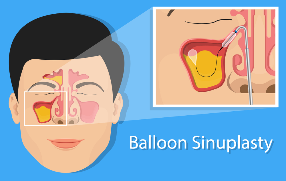 Long-Term Side Effects of Balloon Sinuplasty